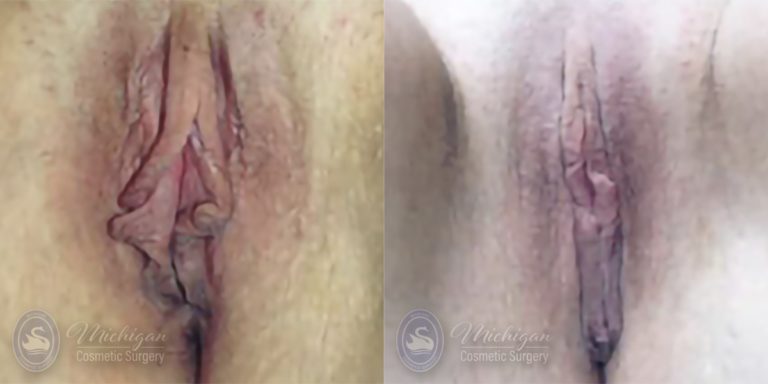 Labiaplasty Before and After Photo by Dr. Awada in Southfield Michigan