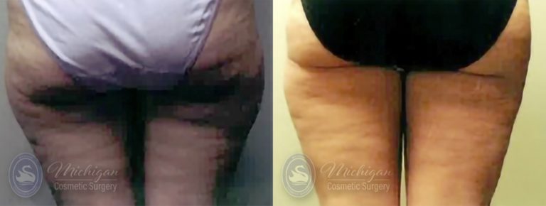 Thigh Lift Before and After Photo by Dr. Awada in Southfield Michigan