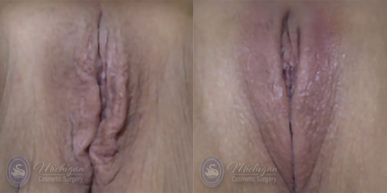 Labiaplasty Before and After Photo by Dr. Awada in Southfield Michigan
