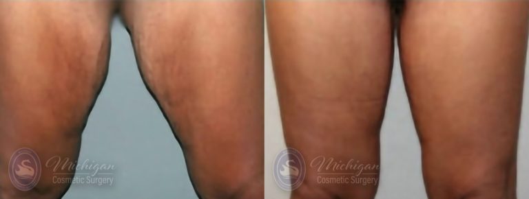 Thigh Lift Before and After Photo by Dr. Awada in Southfield Michigan