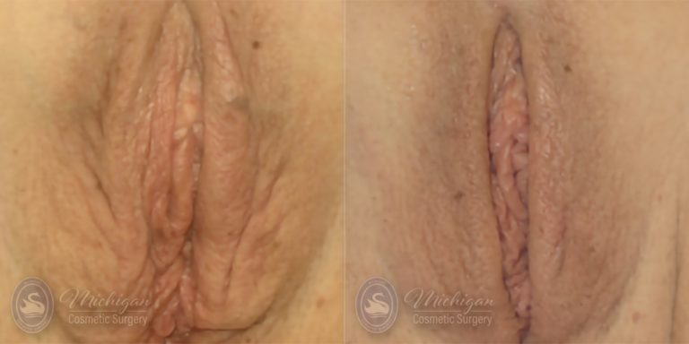 Liposuction Before and After Photo by Dr. Awada in Southfield Michigan