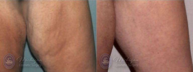 Thigh Lift Before and After Photo by Dr. Awada in Southfield Michigan