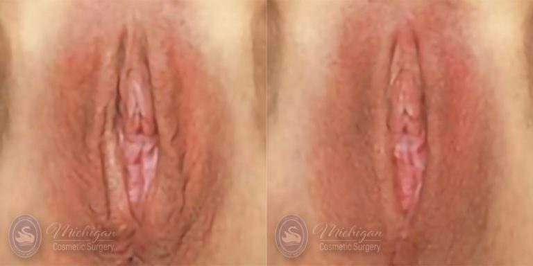 Labiaplasty Before and After Photo by Dr. Awada in Southfield Michigan