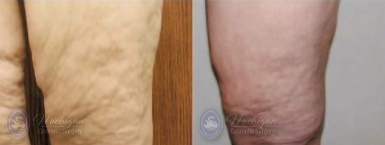 Thigh Lift Before and After Photo by Dr. Awada in Southfield Michigan