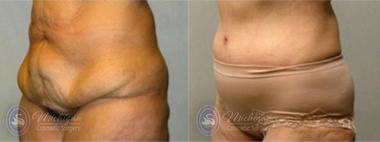 Tummy Tuck Before and After Photo by Dr. Awada in Southfield Michigan