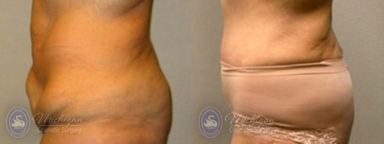 Tummy Tuck Before and After Photo by Dr. Awada in Southfield Michigan