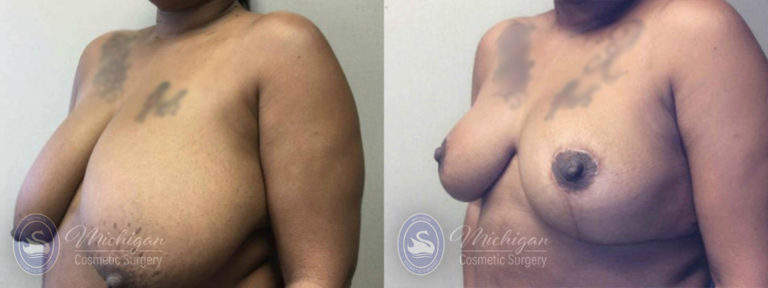 Breast Reduction Before and After Photo by Dr. Awada in Southfield Michigan