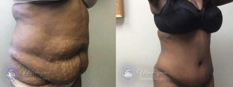 Tummy Tuck Before and After Photo by Dr. Awada in Southfield Michigan