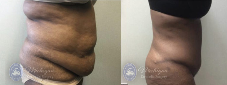 Tummy Tuck Before and After Photo by Dr. Awada in Southfield Michigan