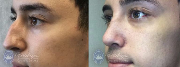 Rhinoplasty Before and After Photo by Dr. Awada in Southfield Michigan
