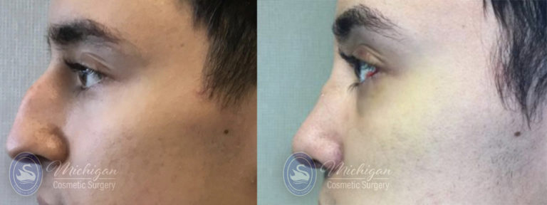 Rhinoplasty Before and After Photo by Dr. Awada in Southfield Michigan