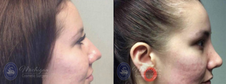 Rhinoplasty Before and After Photo by Dr. Awada in Southfield Michigan