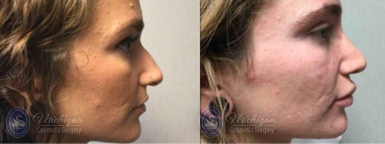 Rhinoplasty Before and After Photo by Dr. Awada in Southfield Michigan