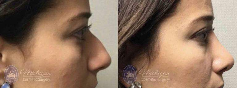 Rhinoplasty Before and After Photo by Dr. Awada in Southfield Michigan
