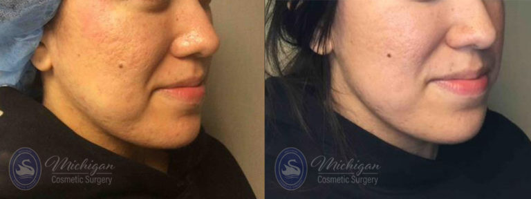 Acne Removal Before and After Photo by Dr. Awada in Southfield Michigan