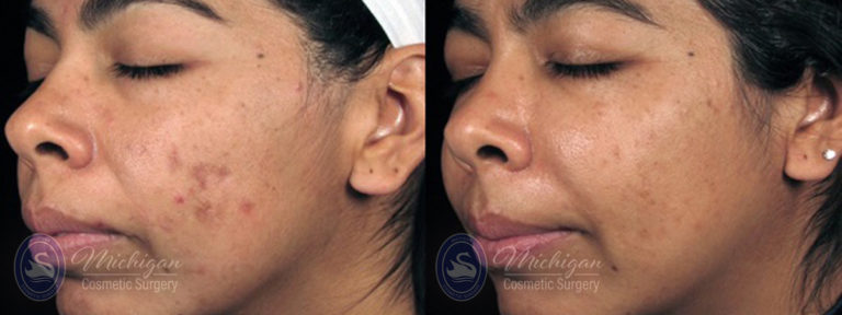 Acne Removal Before and After Photo by Dr. Awada in Southfield Michigan