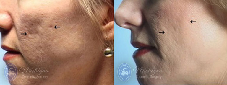 Acne Removal Before and After Photo by Dr. Awada in Southfield Michigan