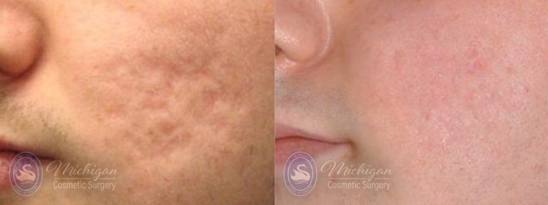 Acne Removal Before and After Photo by Dr. Awada in Southfield Michigan