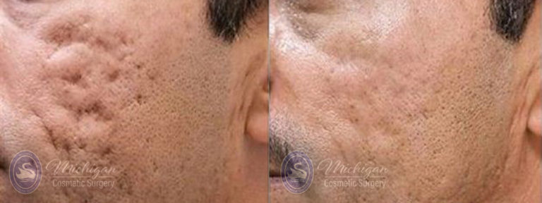 Acne Removal Before and After Photo by Dr. Awada in Southfield Michigan