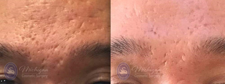 Acne Removal Before and After Photo by Dr. Awada in Southfield Michigan