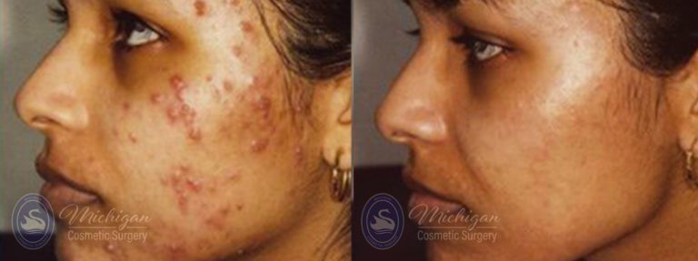 Acne Removal Before and After Photo by Dr. Awada in Southfield Michigan