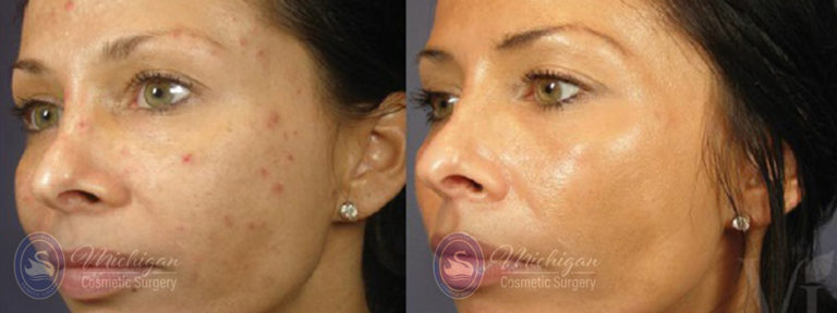 Acne Removal Before and After Photo by Dr. Awada in Southfield Michigan