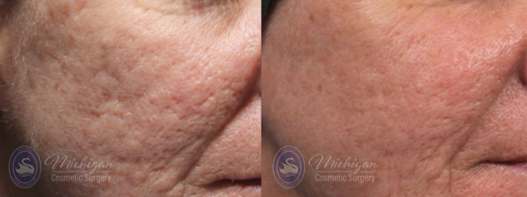 Acne Removal Before and After Photo by Dr. Awada in Southfield Michigan