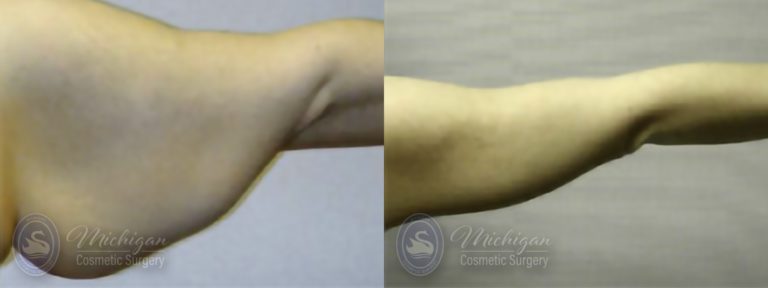 Arm Lift Before and After Photo by Dr. Awada in Southfield Michigan
