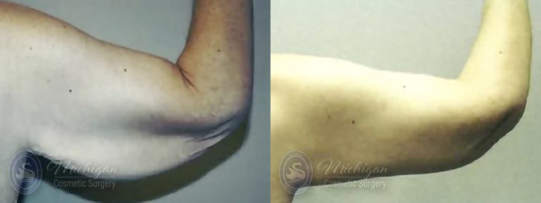 Arm Lift Before and After Photo by Dr. Awada in Southfield Michigan