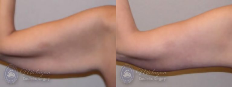 Arm Lift Before and After Photo by Dr. Awada in Southfield Michigan