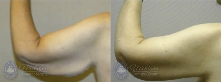 Arm Lift Before and After Photo by Dr. Awada in Southfield Michigan