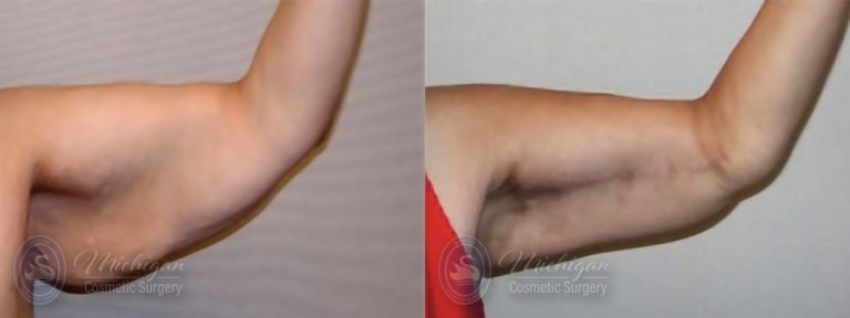 Arm Lift Before and After Photo by Dr. Awada in Southfield Michigan