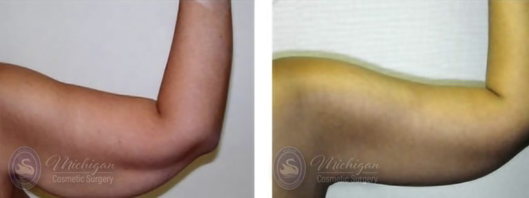 Arm Lift Before and After Photo by Dr. Awada in Southfield Michigan