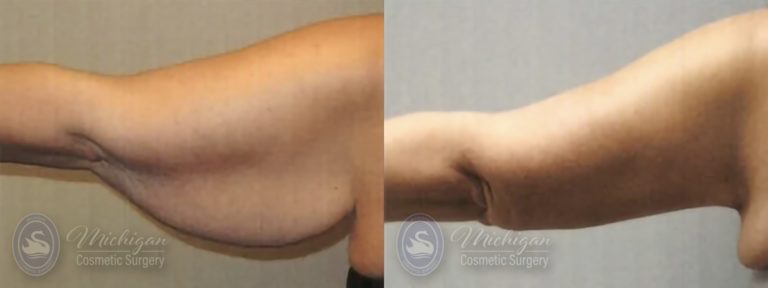 Arm Lift Before and After Photo by Dr. Awada in Southfield Michigan