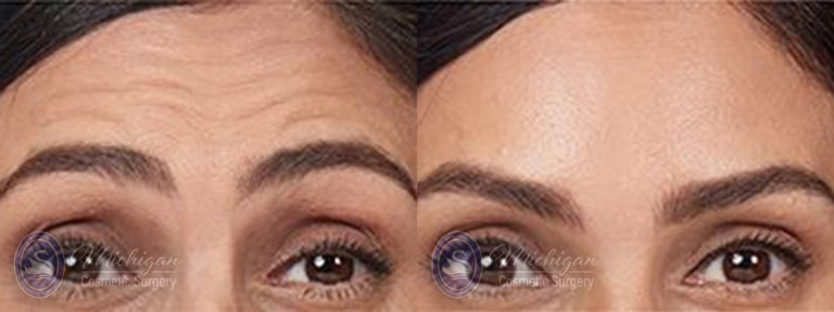 Botox Before and After Photo by Dr. Awada in Southfield Michigan
