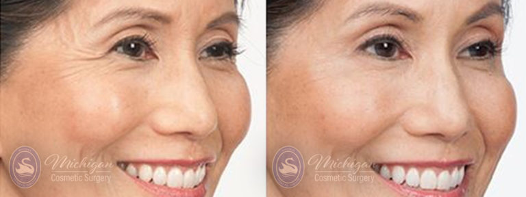 Botox Before and After Photo by Dr. Awada in Southfield Michigan