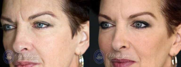 Botox Before and After Photo by Dr. Awada in Southfield Michigan