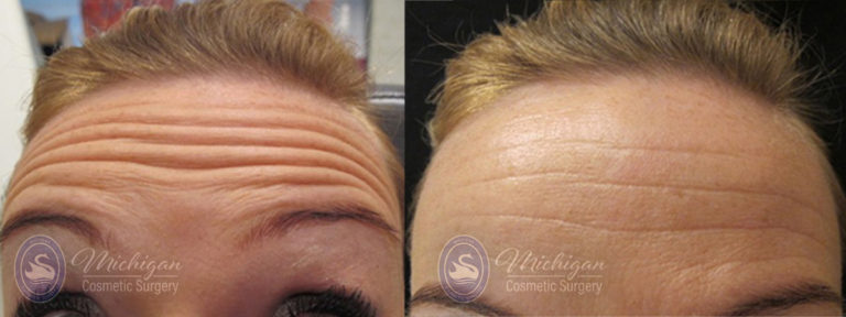 Botox Before and After Photo by Dr. Awada in Southfield Michigan