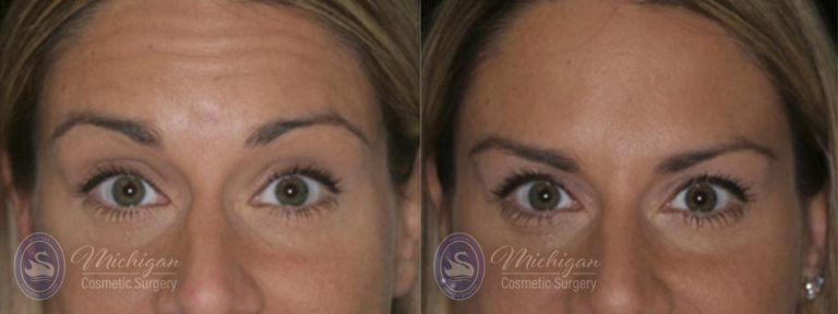 Botox Before and After Photo by Dr. Awada in Southfield Michigan