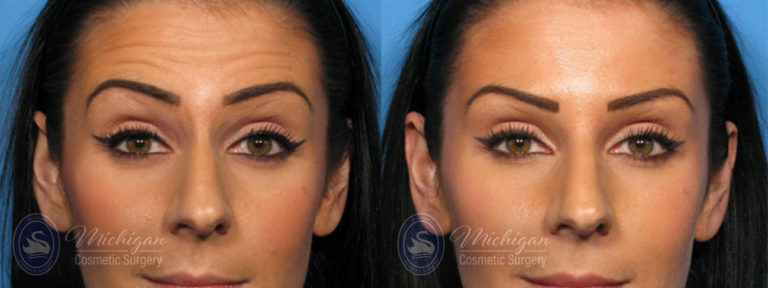 Botox Before and After Photo by Dr. Awada in Southfield Michigan