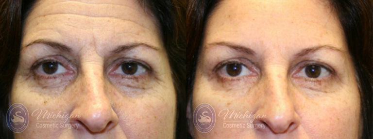Botox Before and After Photo by Dr. Awada in Southfield Michigan