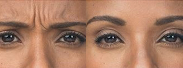 Botox Before and After Photo by Dr. Awada in Southfield Michigan