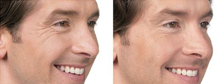 Botox Before and After Photo by Dr. Awada in Southfield Michigan