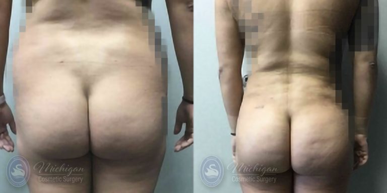Brazilian Butt Lift Before and After Photo by Dr. Awada in Southfield Michigan