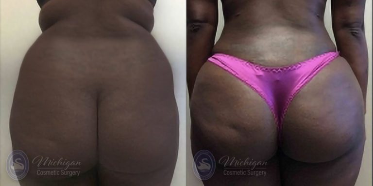 Brazilian Butt Lift Before and After Photo by Dr. Awada in Southfield Michigan