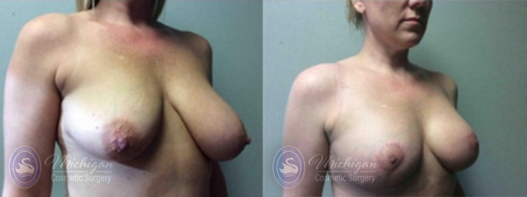 Breast Asymmetry Before and After Photo by Dr. Awada in Southfield Michigan