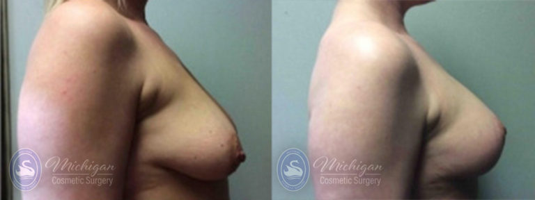 Breast Asymmetry Before and After Photo by Dr. Awada in Southfield Michigan