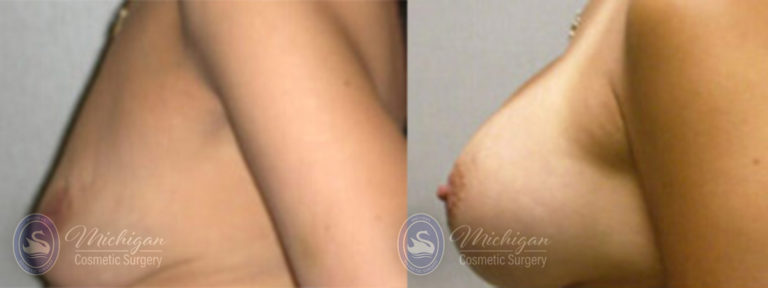 Breast Asymmetry Before and After Photo by Dr. Awada in Southfield Michigan