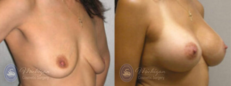 Breast Asymmetry Before and After Photo by Dr. Awada in Southfield Michigan