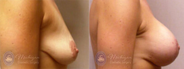 Breast Asymmetry Before and After Photo by Dr. Awada in Southfield Michigan